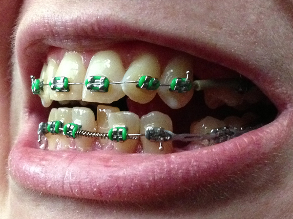 do braces move your teeth everyday