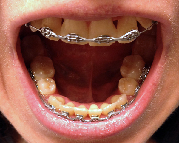 bottom teeth after braces adjustment number eight