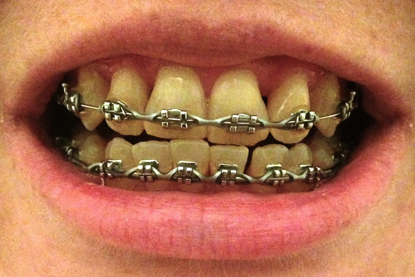 September 2013 Braces Adjustment