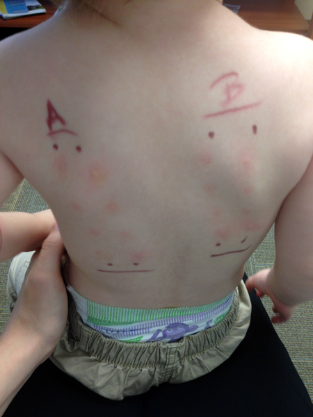 Allergy Test