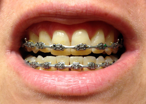 braces adjustment, september 2014