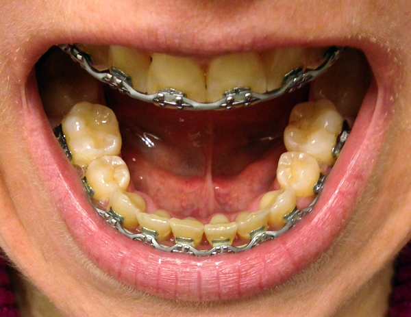 braces, bottom teeth