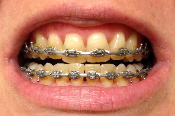 braces