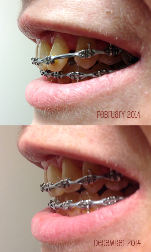 braces, feb vs. dec