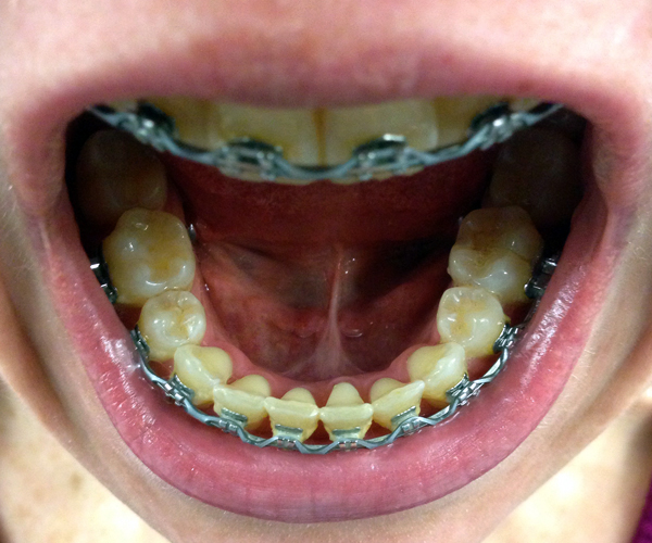 braces bottom teeth