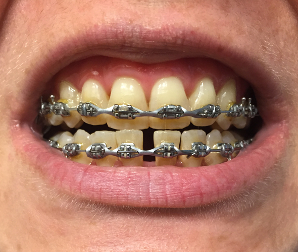 Braces, Day 956